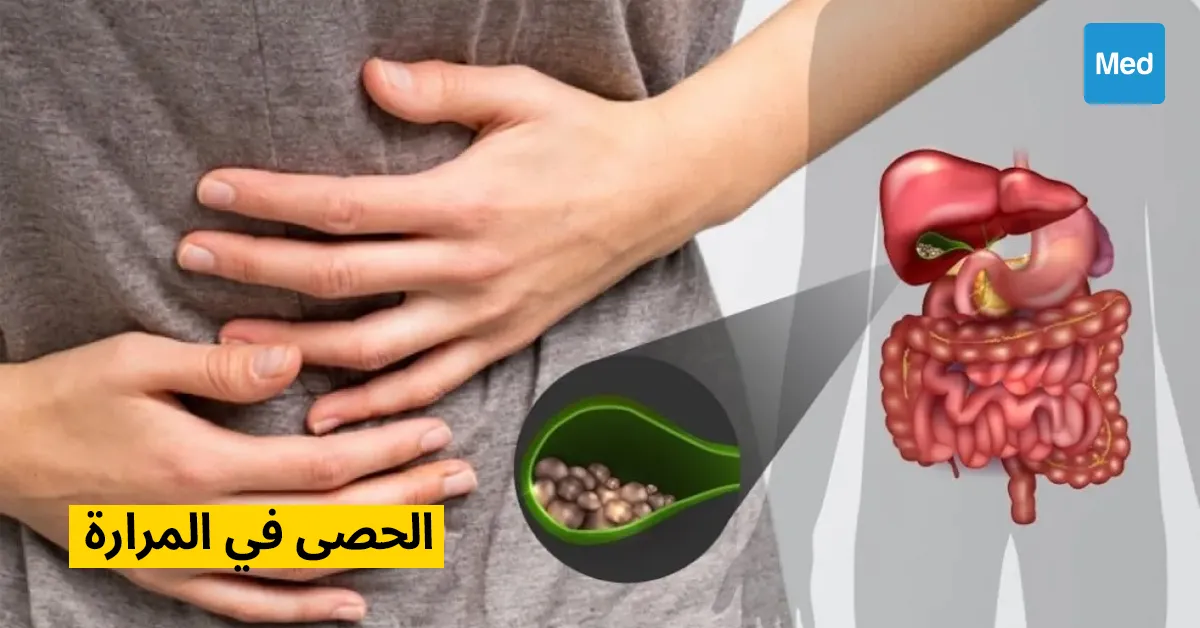 الحصى في المرارة